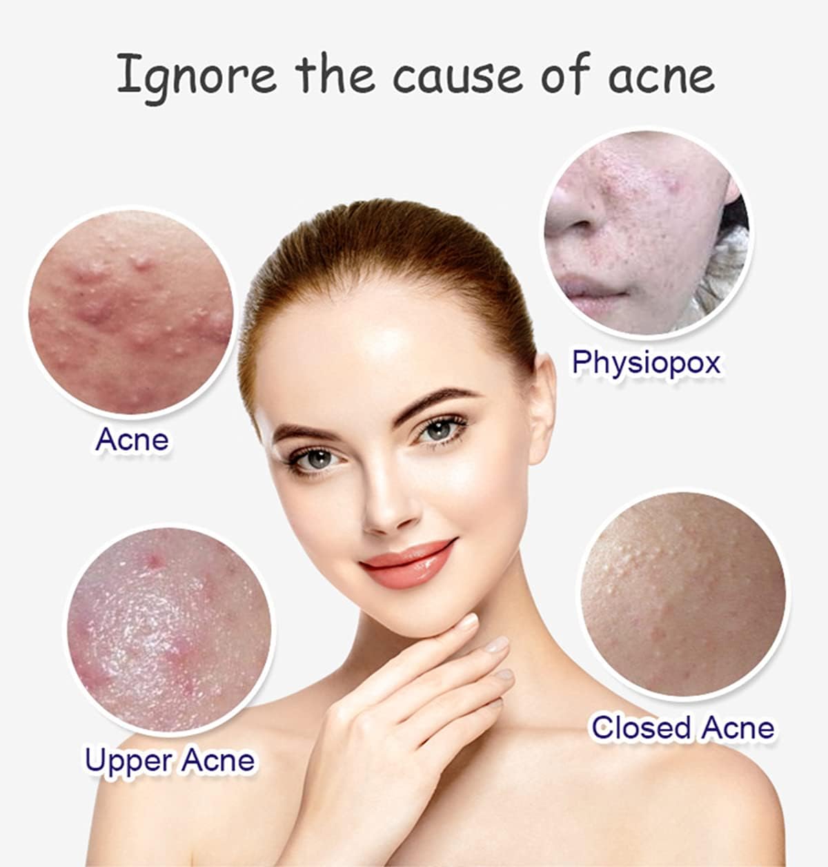 Aichun Beauty Anti - Acne Whitening Facial Serum Aloe Vera Extract Salicylic Acid Repairs Damaged Skin | 30ml - Image 6
