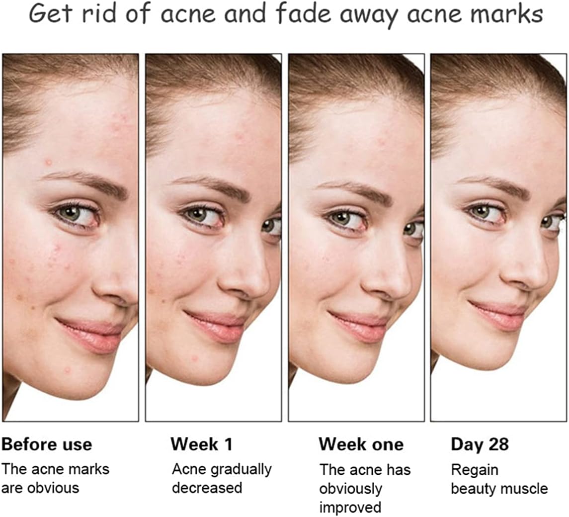 Aichun Beauty Anti - Acne Whitening Facial Serum Aloe Vera Extract Salicylic Acid Repairs Damaged Skin | 30ml - Image 9