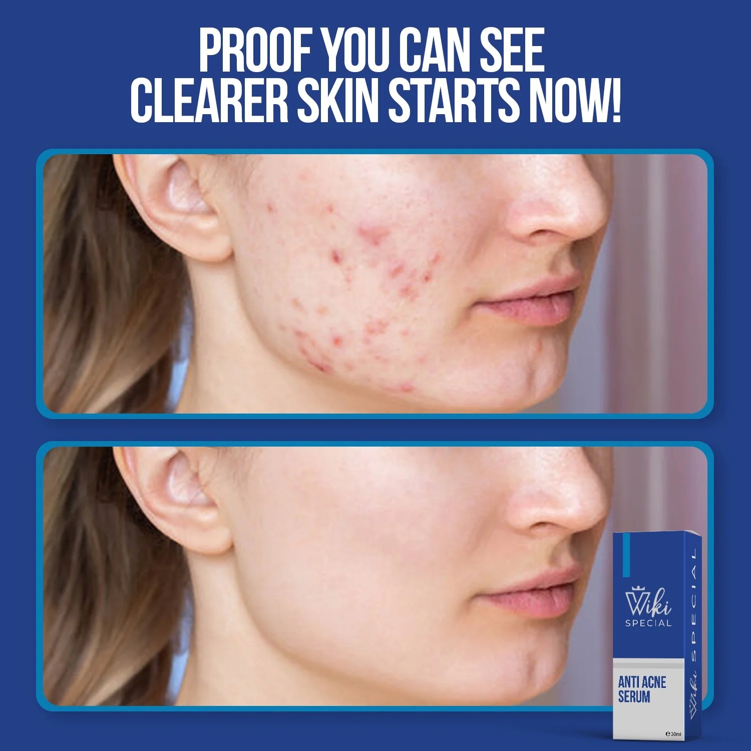 Wiki Special Anti Acne Serum - 30ml | Clears Acne, Soothes Skin & Fights Blemishes - Image 5